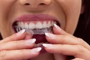 Patient wearing clear aligners