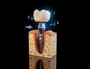 Learn how long dental implants in Brookfield, WI, really last.