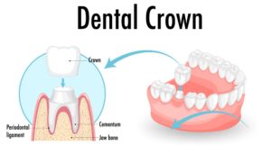 Learn when porcelain crowns in Brookfield, WI, can restore your smile.